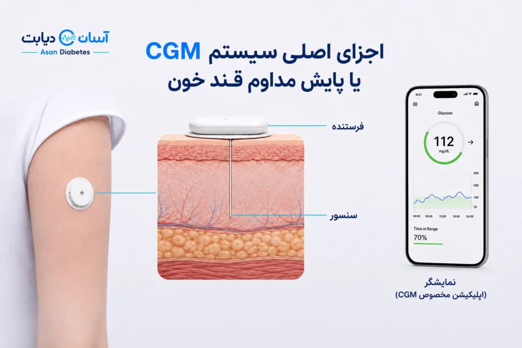 راهنمای خرید و مقایسه سنسورهای قند خون در ایران؛ مزایا، معایب و نکات کلیدی نصب